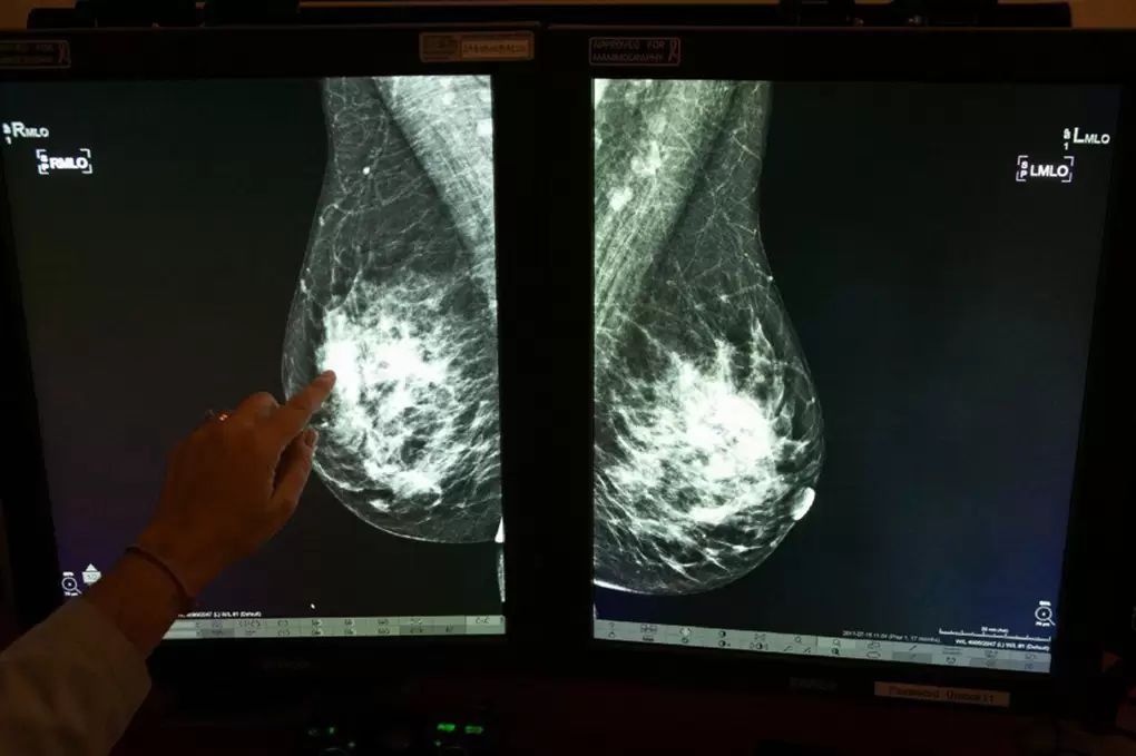 Breast cancer mammogram